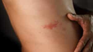 Man with shingles showing red, blistering rash on skin caused by the Herpes zoster virus, representing symptoms and medical concerns related to shingles
